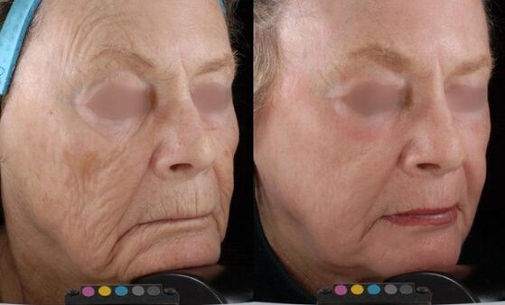 Photos before and after laser rejuvenation