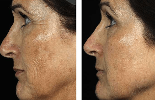 Before and after facial rejuvenation
