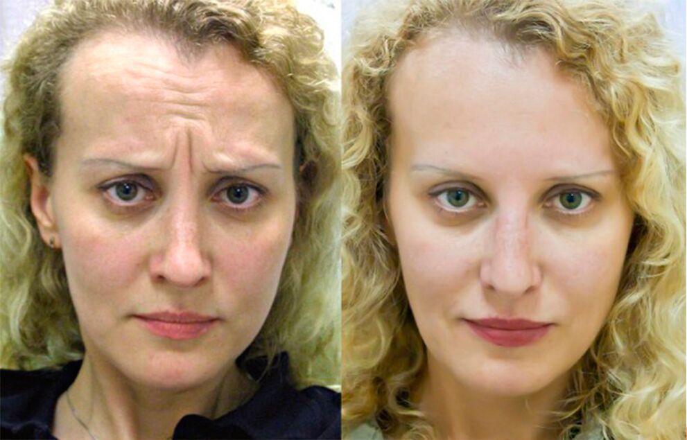 Before and after using a massager to rejuvenate ltza photo 1