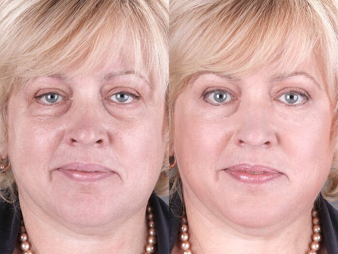 Before and after using a massager to rejuvenate ltza photo 3