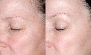 Rejuvenation of the skin around the eyes before and after taking pictures