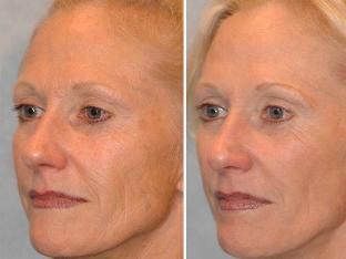 Before and after microcurrent treatment
