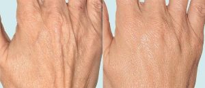 Hand skin before and after fractionated treatment