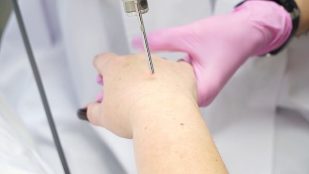 Laser repair hand skin