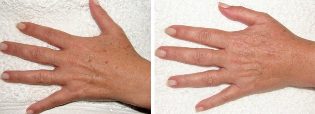 The result of removing age spots on hands