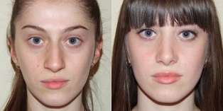 Before and after plasma skin regeneration