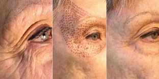Photos before and after plasma rejuvenation