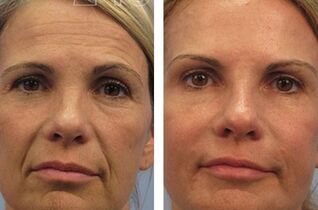 Mesotherapy results